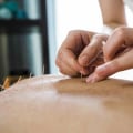 Acupuncture for Natural Relief from Menopausal Symptoms