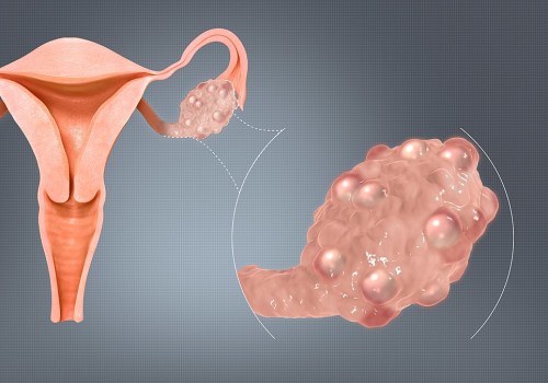 Understanding Polycystic Ovary Syndrome (PCOS) and Hormone Replacement Therapy